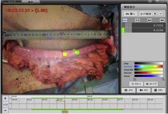食管切除术中评估血流灌注量 吲哚菁绿荧光成像可定量（转载）