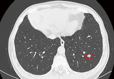 A Successful Thoracic Fluorescence-guided Surgery in General Hospital of Shenzhen University