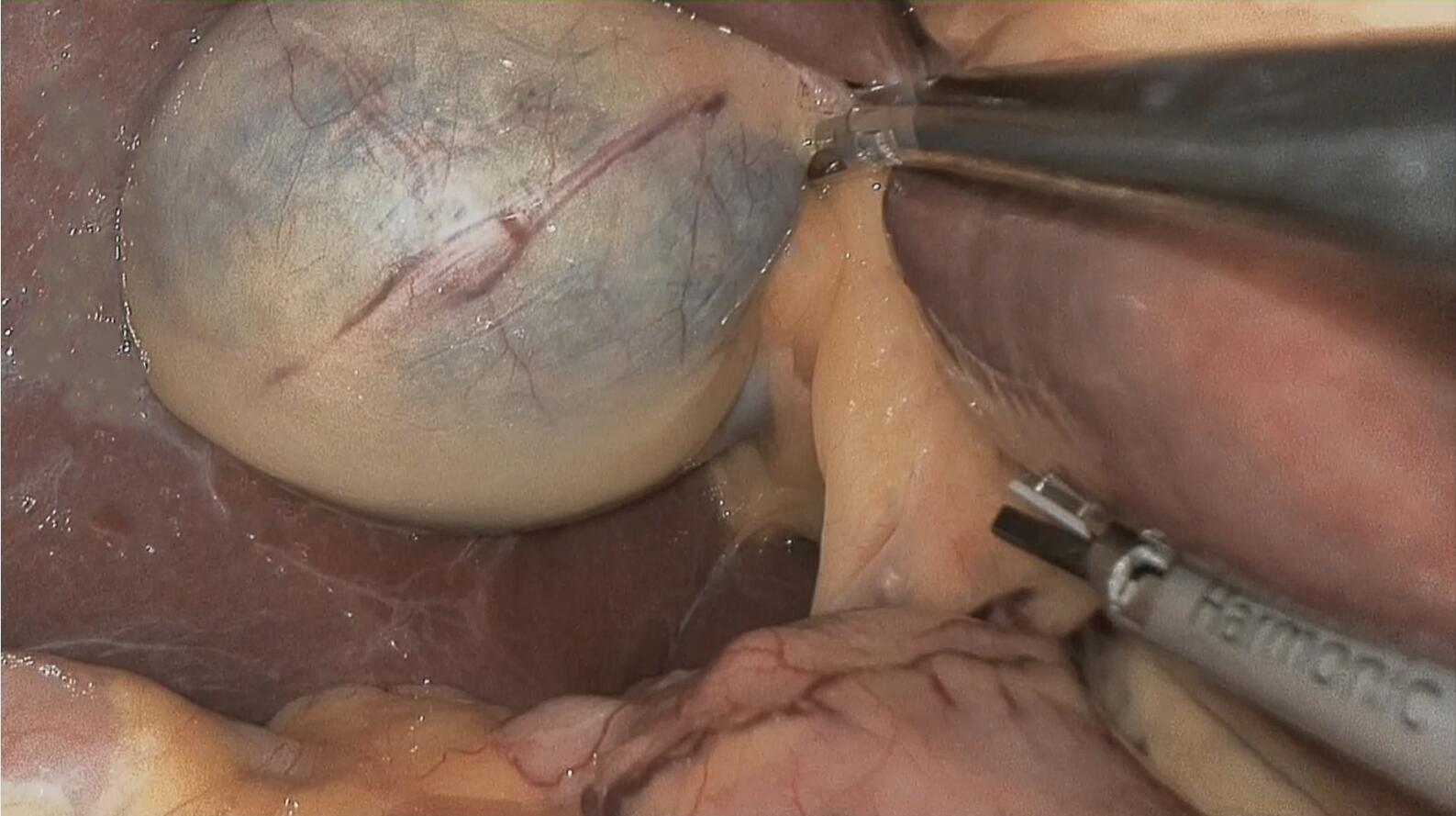 Intraoperative biliary tract visualization