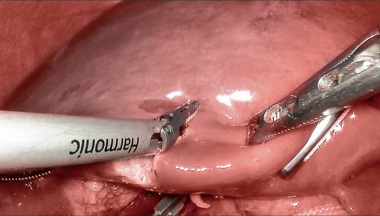 Hepatic segment/subsegment identification