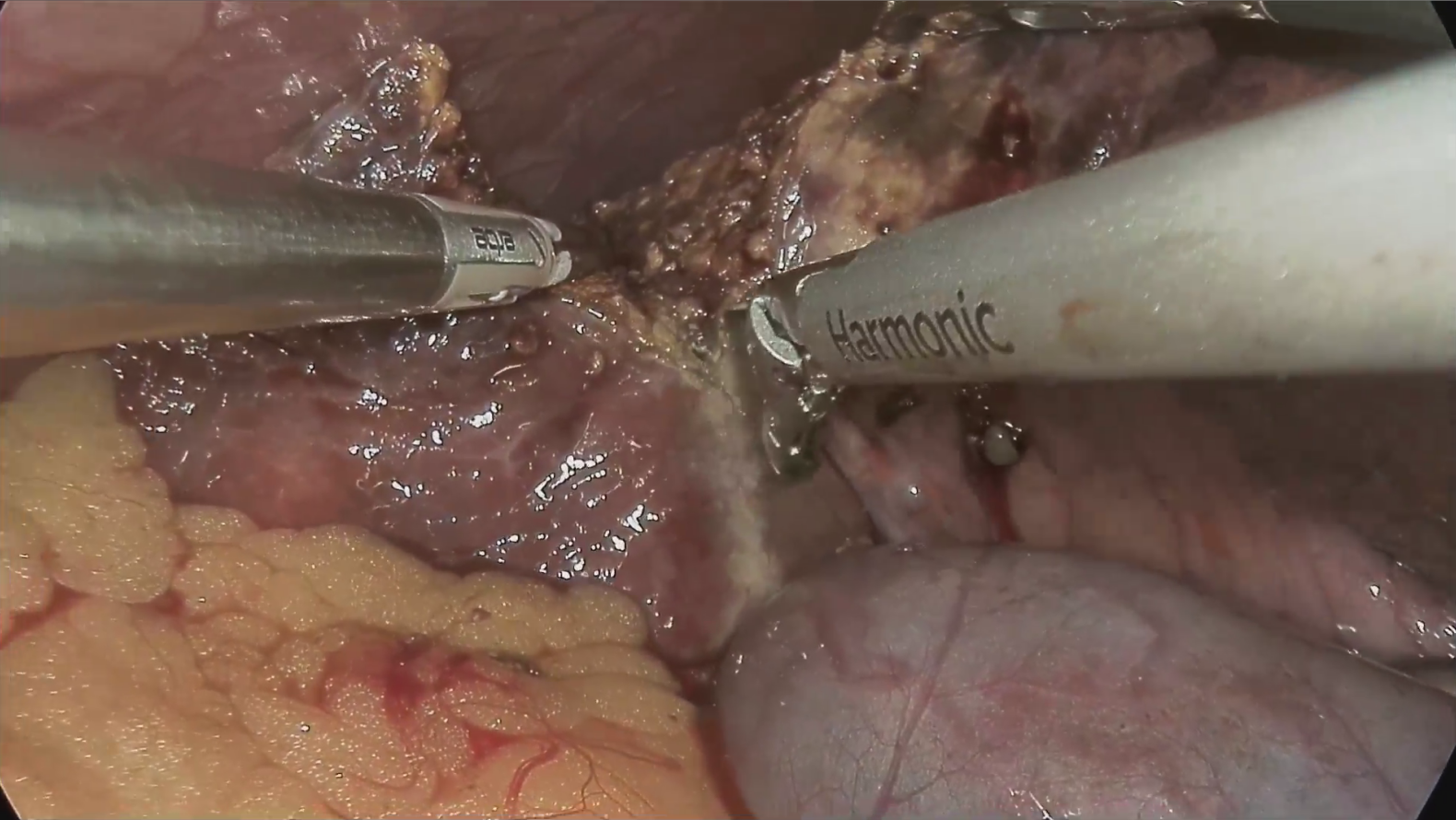 Intraoperative identification of hepatic tumor