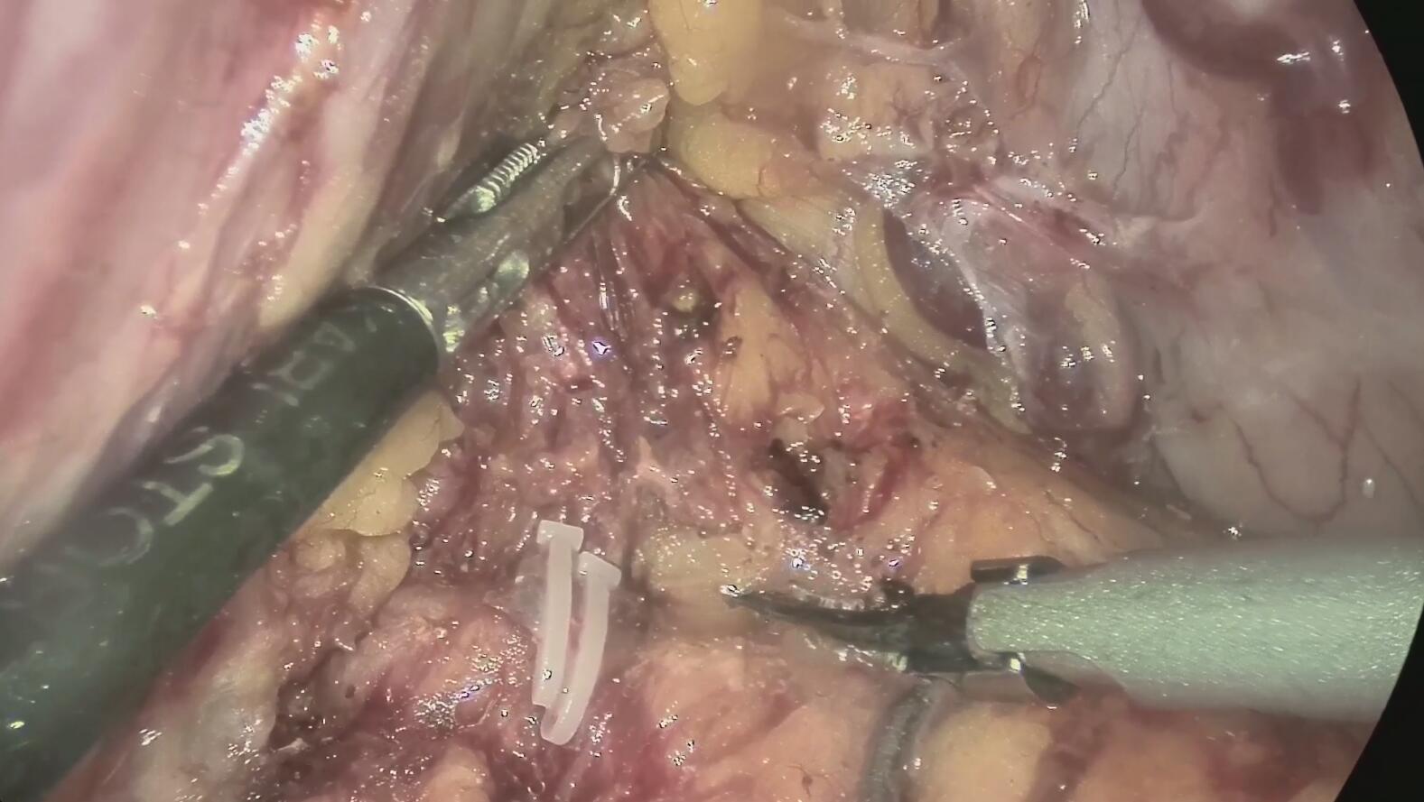 Lymph node tracing of gastrointestinal tumor