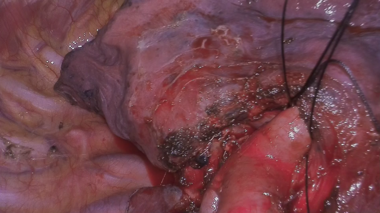 Pulmonary segments visualization