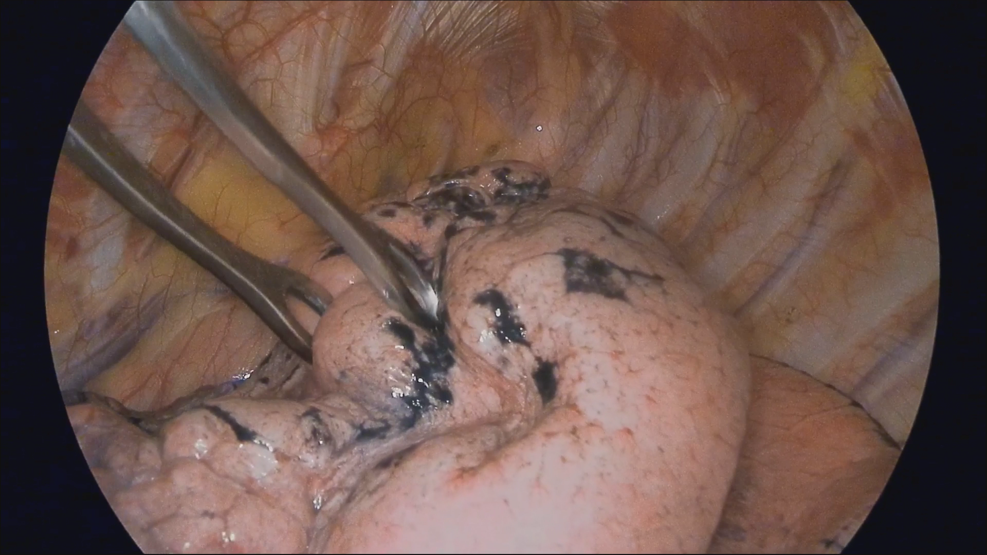 Localization of Pulmonary Nodules