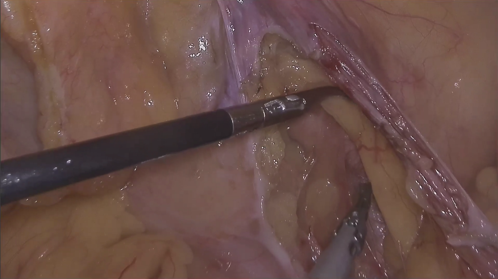 Lymph node tracing of prostate cancer