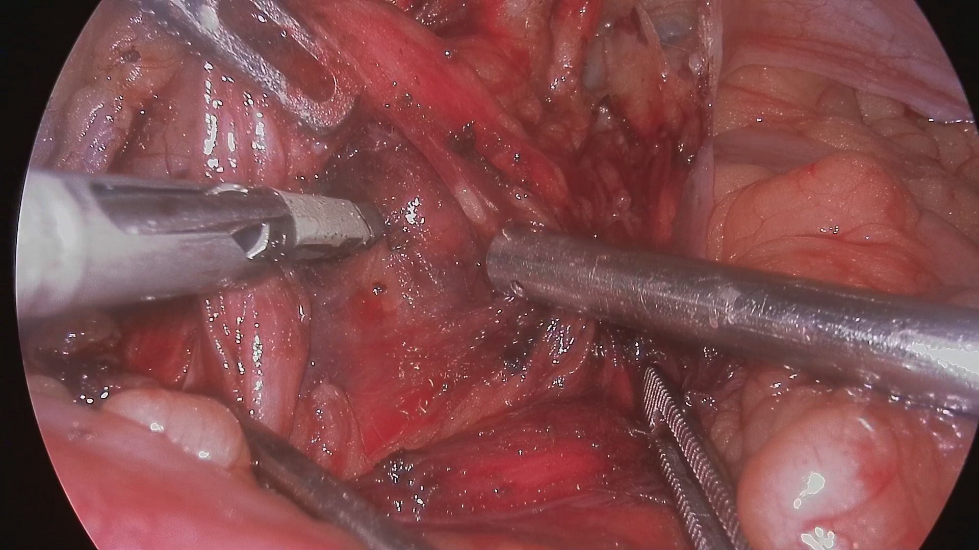 Lymph node tracing of bladder cancer